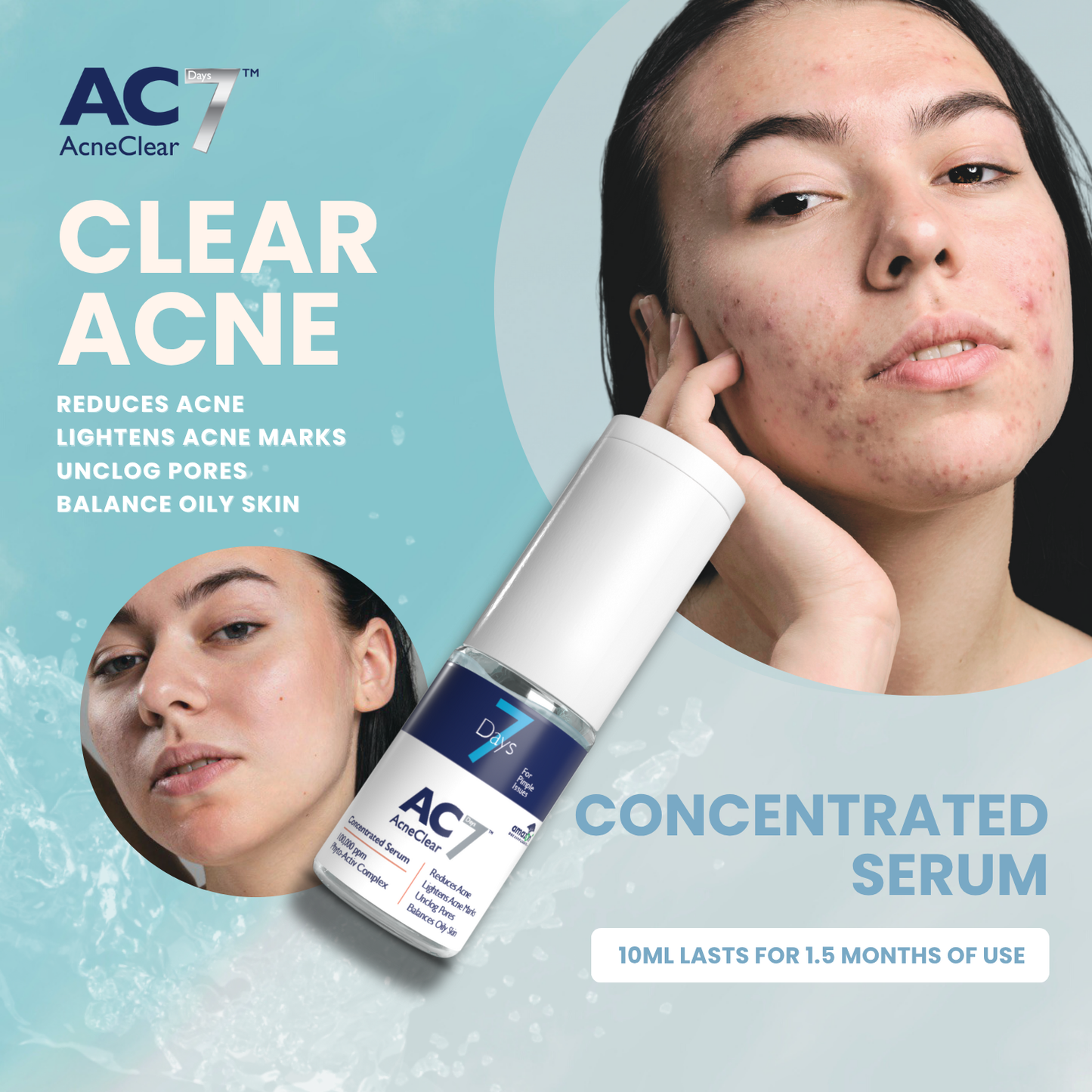 AC7D Serum Concentrated 10ml (Low Stock) - Acne Clear 7 Days | Acne Treatment for Acne-Prone Skin | Lighten Acne Marks | Reduce Acne Pimples Breakout | 7 days Visible Results | Fast-Acting | Clear Skin