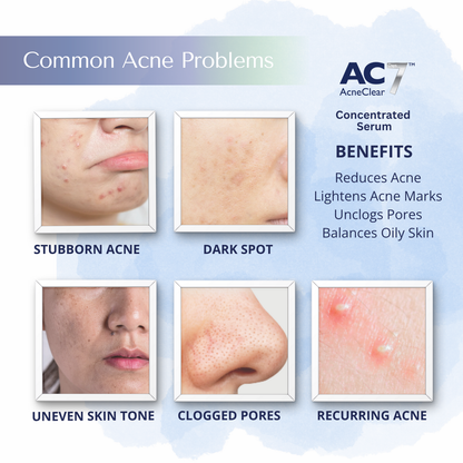 AcneClear7 Days Concentrated Serum