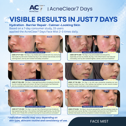 AC7D Face Mist 50ml - Oil Control & Acne Relief Spray