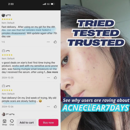AcneClear7 Days Concentrated Serum